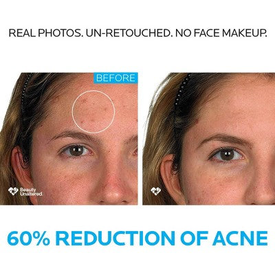 La Roche Posay Effaclar Dermatological Acne Treatment 3-Step System Kit with Medicated Gel Cleanser 7.5 fl oz - Imperfect Box