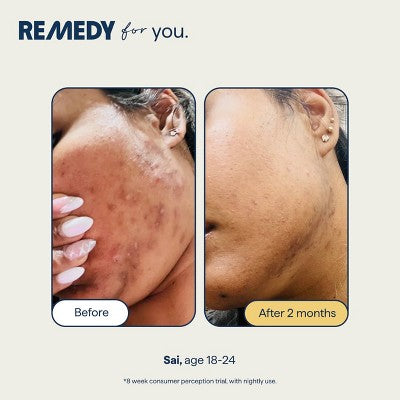 Remedy Skin Serum for Dark Spots and Discoloration 1 fl oz - Missing Box