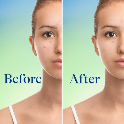 Differin Maximum Strength Foaming Acne Face and Body Wash with 10% Benzoyl Peroxide 5 fl oz - Imperfect Box