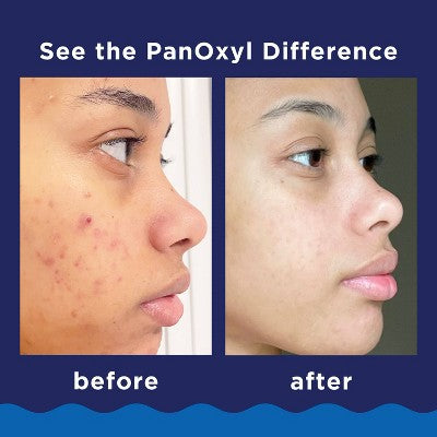 PanOxyl 10% Benzoyl Peroxide Acne Foaming Wash 5.5oz - Imperfect Box