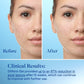 Differin Acne Retinoid Face and Body Treatment Gel Adapalene 0.1% 45g - Imperfect Box