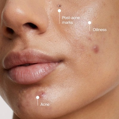 Neutrogena Evenly Clear Acne Cleansing Mask with Benzoyl Peroxide 4.2 fl oz - Imperfect Box
