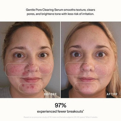 Versed Skin Refine Gentle Pore Clearing Serum 1 fl oz - Imperfect Box