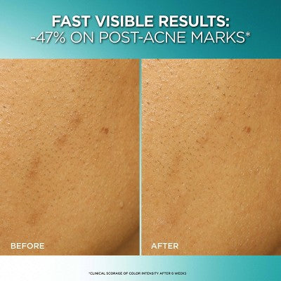 L'Oreal Paris Bright Reveal Dark Spot Exfoliant Peel - Imperfect Box