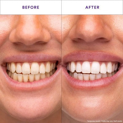 Hismile V34 Teeth Whitening Strips 14pk - Imperfect Box