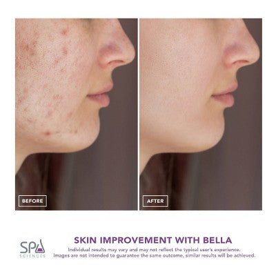 Spa Sciences BELLA 3-in-1 Diamond Tip Microdermabrasion System - Imperfect Box