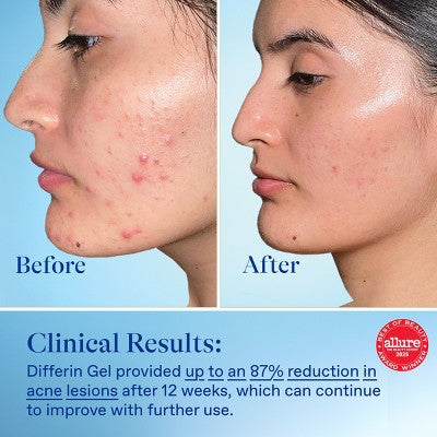 Differin Acne Retinoid Face and Body Treatment Gel Adapalene 0.1% 15g - Imperfect Box